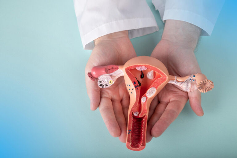 Fibroid Uterus