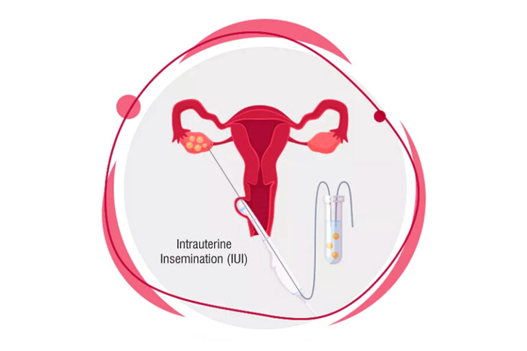 IUI