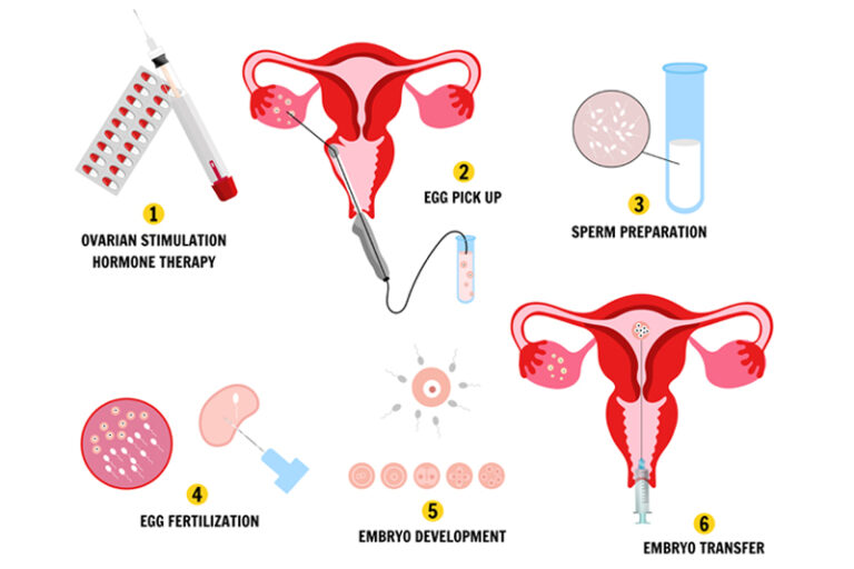 IVF