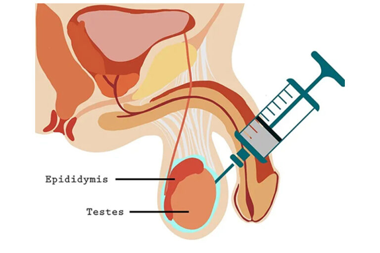 Testicular Sperm Aspiration